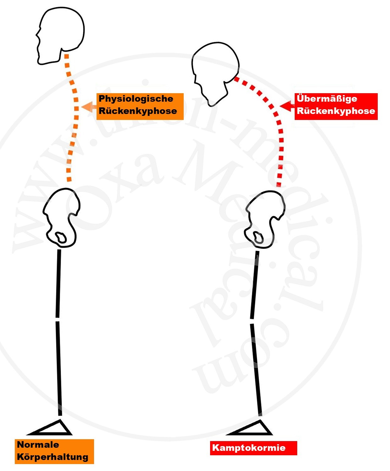 Diagramm der Camptocormie